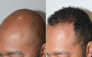 patient-120459-hair-transplants-for-men-before-after-5-scaled-1-1024x637